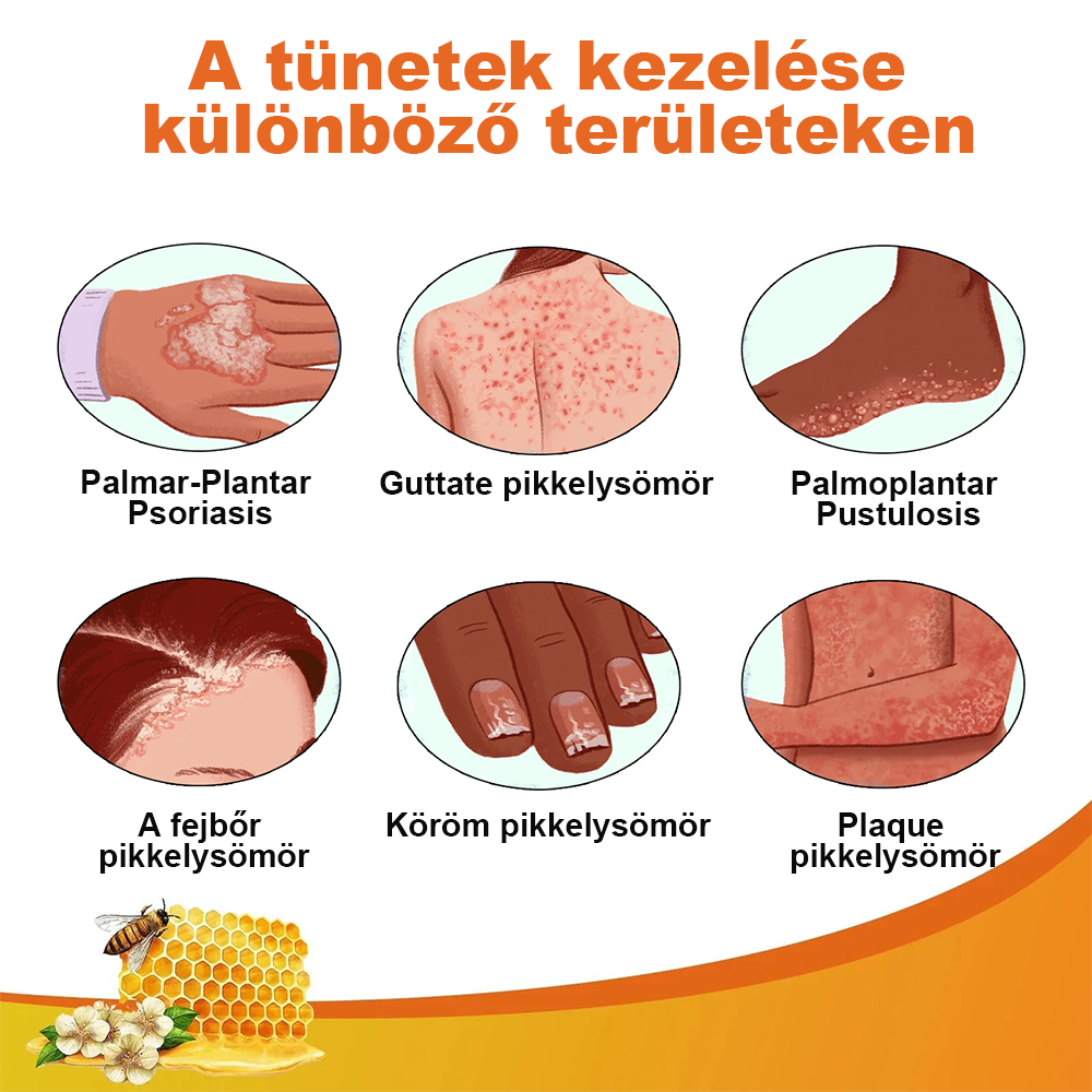 đCvreoz mĂ©hmĂ©reg pikkelysömör kezelĂ©sĂ©re krĂ©m (đšââAAD AJĂNLJA)đđ