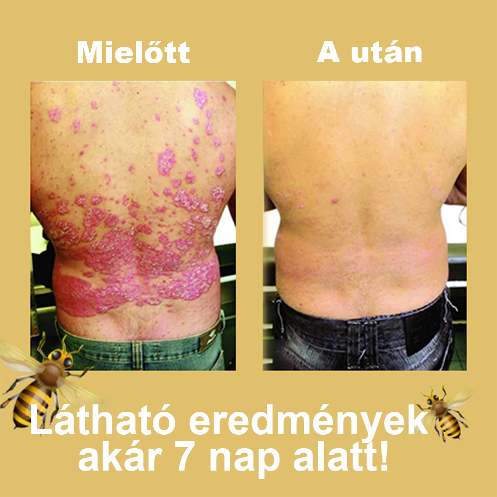 đCvreoz mĂ©hmĂ©reg pikkelysömör kezelĂ©sĂ©re krĂ©m (đšââAAD AJĂNLJA)đđ