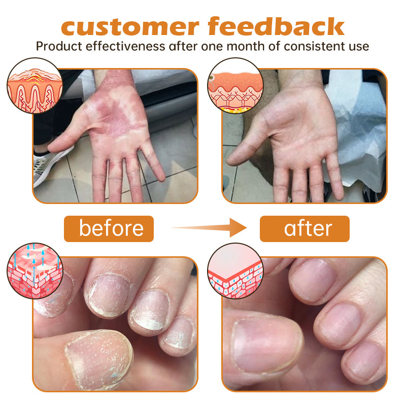 đŸCvreozâą PsoriaHeal Bee Venom Psoriasis Treatment Spray(Suitable for all skin conditions)