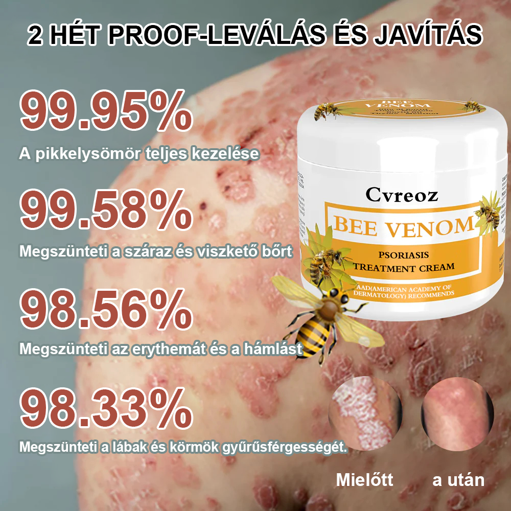 đCvreoz mĂ©hmĂ©reg pikkelysömör kezelĂ©sĂ©re krĂ©m (đšââAAD AJĂNLJA)đđ