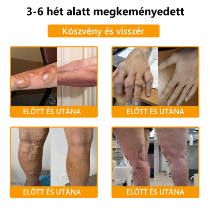 ArthroFree™ méhméreg fájdalomcsillapító és csontgyógyító krém (🐝Kifejezetten idősek számára készült, az OGYÉI ajánlja)