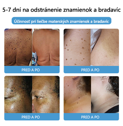 🌈[✨Posledný deň 50% zľava✨]🐝🐝🐝 Krém na ošetrenie krtkov a bradavíc s včelím jedom Lenaro™ (👨‍⚕EDQM ODPORÚČA)