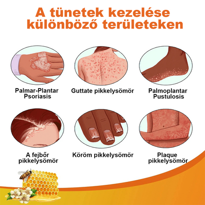 🌟Cvreoz méhméreg pikkelysömör kezelésére krém (👨‍⚕AAD AJÁNLJA)🐝🐝