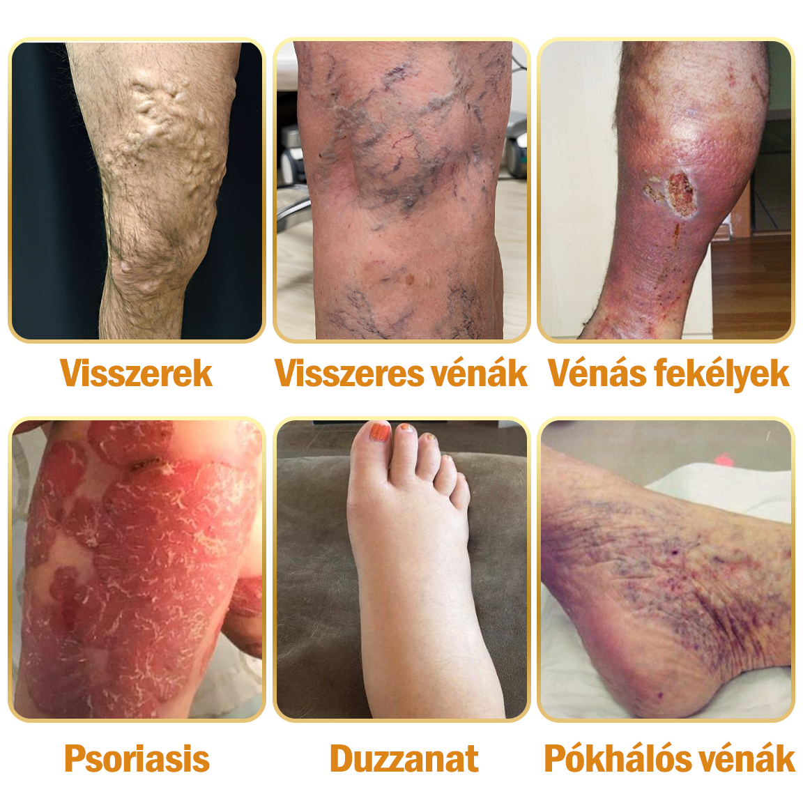 Zoencgz™👨‍⚕️✨Hivatalos márkabolt✨Méhméreg Arthritis & Varicose Vein Treatment Cream (NIPN & HSP Recommends)