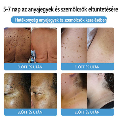 🌟[✨Utolsó nap 50% kedvezménnyel✨]🐝🐝🐝Lenaro™ méhméreg vakond- és szemölcskezelő krém(👨‍⚕AAD AJÁNLJA)