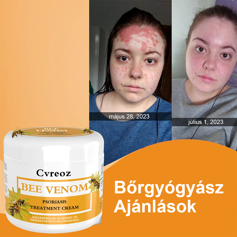 🌟Cvreoz méhméreg pikkelysömör kezelésére krém (👨‍⚕AAD AJÁNLJA)🐝🐝