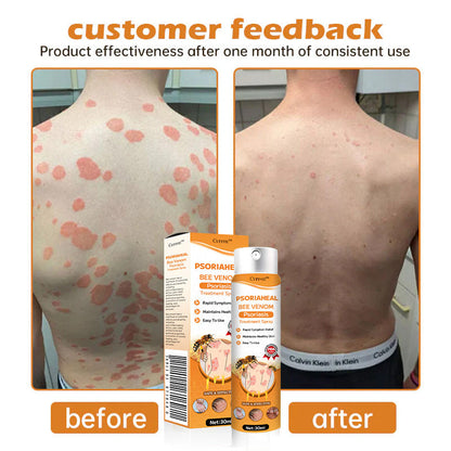 👾Cvreoz™ PsoriaHeal Bee Venom Psoriasis Treatment Spray(Suitable for all skin conditions)