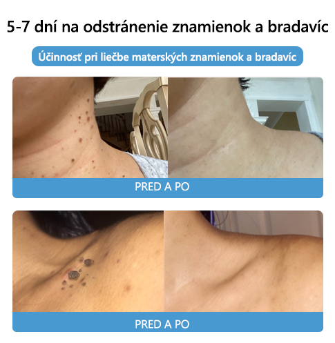 🌈[✨Posledný deň 50% zľava✨]🐝🐝🐝 Krém na ošetrenie krtkov a bradavíc s včelím jedom Lenaro™ (👨‍⚕EDQM ODPORÚČA)