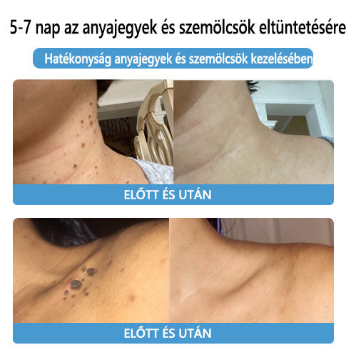 🌟[✨Utolsó nap 50% kedvezménnyel✨]🐝🐝🐝Lenaro™ méhméreg vakond- és szemölcskezelő krém(👨‍⚕AAD AJÁNLJA)