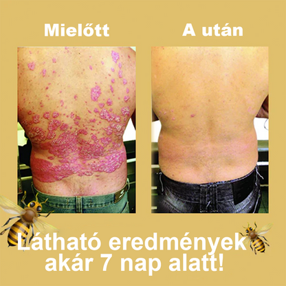 🌟Cvreoz méhméreg pikkelysömör kezelésére krém (👨‍⚕AAD AJÁNLJA)🐝🐝