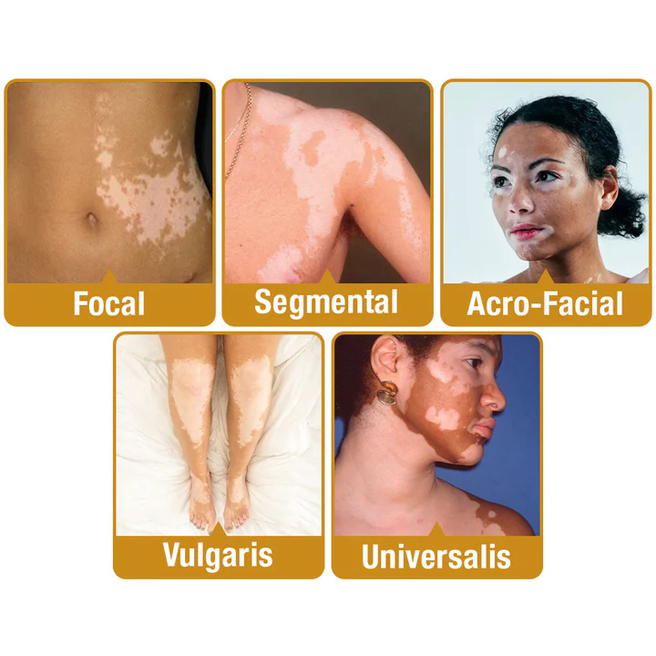 🍀Awzlove™ BeeVenom Vitiligo Treatment Cream(🎉Suitable for all ages, including the elderly and children)