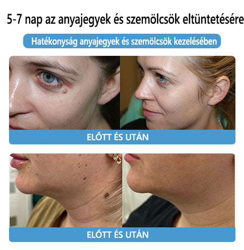 🌟[✨Utolsó nap 50% kedvezménnyel✨]🐝🐝🐝Lenaro™ méhméreg vakond- és szemölcskezelő krém(👨‍⚕AAD AJÁNLJA)