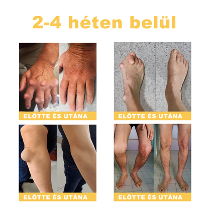 Zoencgz™👨‍⚕️✨Hivatalos márkabolt✨Méhméreg Arthritis & Varicose Vein Treatment Cream (NIPN & HSP Recommends)